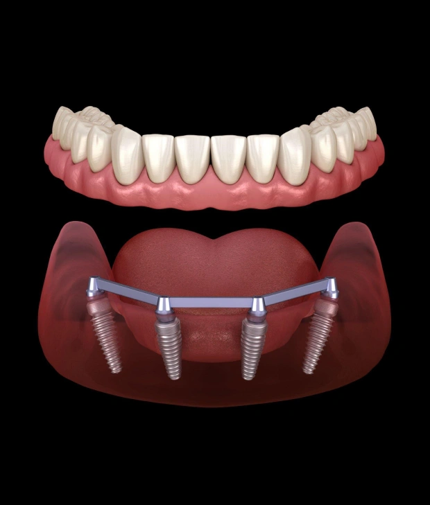 Dental Implants treatment Renton