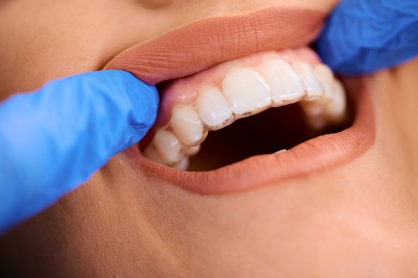 Common Dental Bonding Questions for Patients