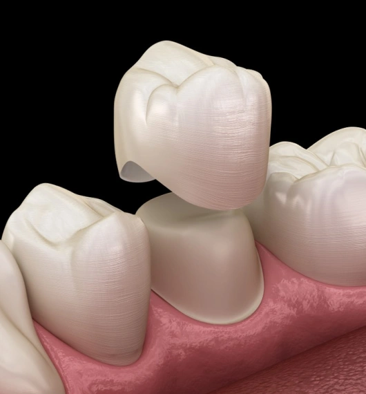 dental crowns in renton