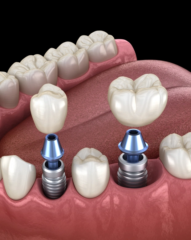 dental implants in renton