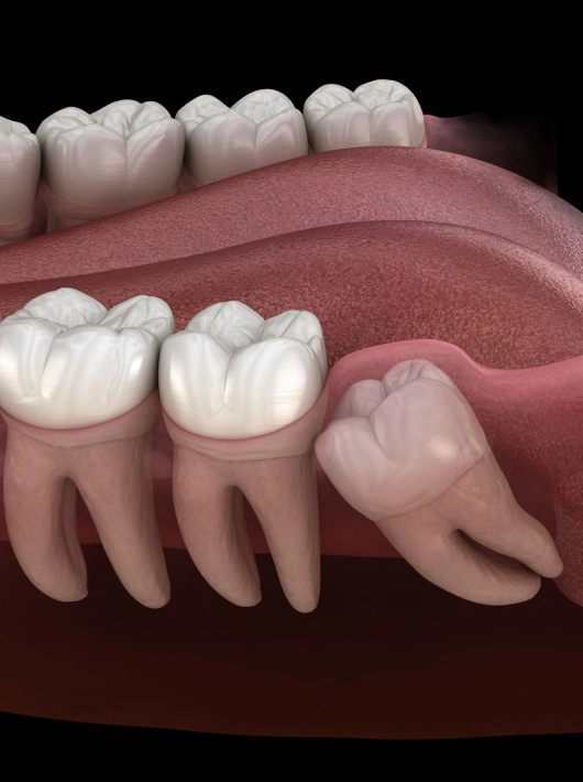 wisdom teeth removal in renton